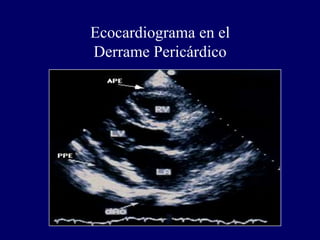 Ecocardiograma en el
Derrame Pericárdico
 