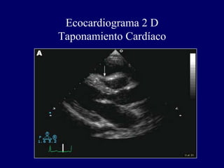 Ecocardiograma 2 D
Taponamiento Cardíaco
 