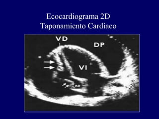 Ecocardiograma 2D
Taponamiento Cardíaco
 