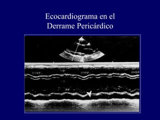 Ecocardiograma en el
Derrame Pericárdico
 