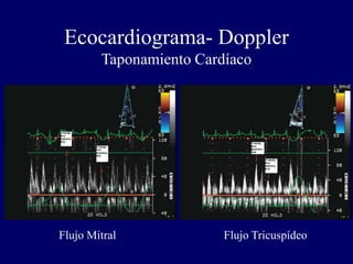Ecocardiograma- Doppler
        Taponamiento Cardíaco




Flujo Mitral             Flujo Tricuspídeo
 