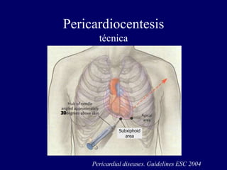 Pericardiocentesis
       técnica




30



               Subxiphoid
                  area




     Pericardial diseases. Guidelines ESC 2004
 