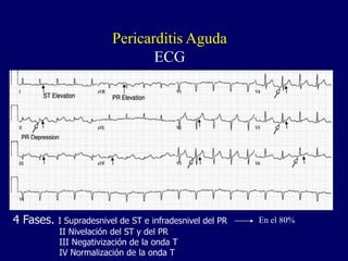 Pericarditis Aguda
                                ECG




4 Fases.   I Supradesnivel de ST e infradesnivel del PR   En el 80%
           II Nivelación del ST y del PR
           III Negativización de la onda T
           IV Normalización de la onda T
 