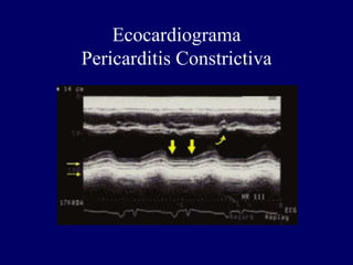 Ecocardiograma
Pericarditis Constrictiva
 