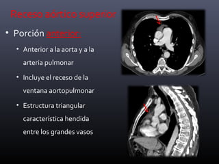 Receso aórtico superior
• Porción anterior:
• Anterior a la aorta y a la
arteria pulmonar
• Incluye el receso de la
ventana aortopulmonar
• Estructura triangular
característica hendida
entre los grandes vasos
 