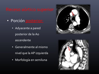 • Porción posterior:
• Adyacente a pared
posterior de la Ao
ascendente
• Generalmente al mismo
nivel que la AP izquierda
• Morfología en semiluna
Receso aórtico superior
 