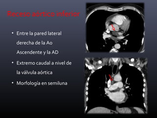 Receso aórtico inferior
• Entre la pared lateral
derecha de la Ao
Ascendente y la AD
• Extremo caudal a nivel de
la válvula aórtica
• Morfología en semiluna
 