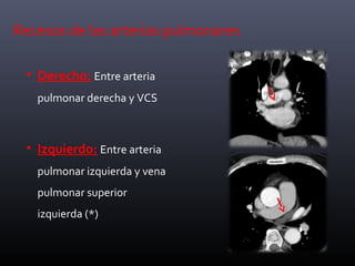Recesos de las arterias pulmonares
• Derecho: Entre arteria
pulmonar derecha y VCS
• Izquierdo: Entre arteria
pulmonar izquierda y vena
pulmonar superior
izquierda (*)
 
