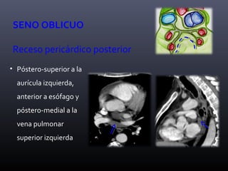SENO OBLICUO
Receso pericárdico posterior
• Póstero-superior a la
aurícula izquierda,
anterior a esófago y
póstero-medial a la
vena pulmonar
superior izquierda
 