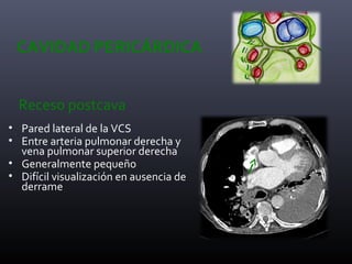 CAVIDAD PERICÁRDICA
Receso postcava
• Pared lateral de la VCS
• Entre arteria pulmonar derecha y
vena pulmonar superior derecha
• Generalmente pequeño
• Difícil visualización en ausencia de
derrame
 