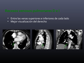 Recesos venosos pulmonares D e I
• Entre las venas superiores e inferiores de cada lado
• Mejor visualización del derecho
 