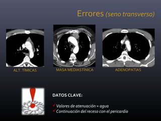 Errores (seno transverso)
DATOS CLAVE:
Valores de atenuación ≈ agua
Continuación del receso con el pericardio
ALT. TÍMICAS MASA MEDIASTÍNICA ADENOPATÍAS
 