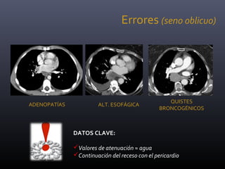 ADENOPATÍAS ALT. ESOFÁGICA
QUISTES
BRONCOGÉNICOS
Errores (seno oblicuo)
DATOS CLAVE:
Valores de atenuación ≈ agua
Continuación del receso con el pericardio
 
