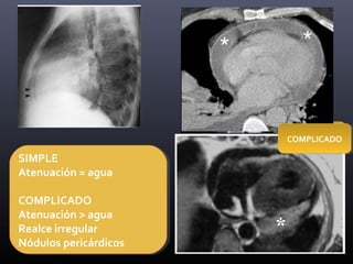 SIMPLESIMPLE
COMPLICADOCOMPLICADO
SIMPLE
Atenuación = agua
COMPLICADO
Atenuación > agua
Realce irregular
Nódulos pericárdicos
SIMPLE
Atenuación = agua
COMPLICADO
Atenuación > agua
Realce irregular
Nódulos pericárdicos
 