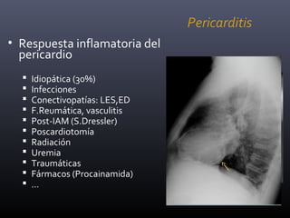 Pericarditis
• Respuesta inflamatoria del
pericardio
 Idiopática (30%)
 Infecciones
 Conectivopatías: LES,ED
 F.Reumática, vasculitis
 Post-IAM (S.Dressler)
 Poscardiotomía
 Radiación
 Uremia
 Traumáticas
 Fármacos (Procainamida)
 …
Inflamación
Fibrosis
P. AGUDA
P.CRÓNICA
INFLAMATORIA
P. CRÓNICA
FIBROSANTE (P.
CONSTRICTIVA)
 