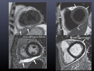 ENGROSAMIENTO + LISO
DERRAME
PLEURAL
VARIABLE
REALCE +
AFECTACIÓN
VENTRICULAR
-
PERICARDITIS AGUDA
Pericarditis no es sinónimo de
engrosamiento
Engrosamiento DIFUSO
Engrosamiento FOCAL SIN Engrosamiento
 
