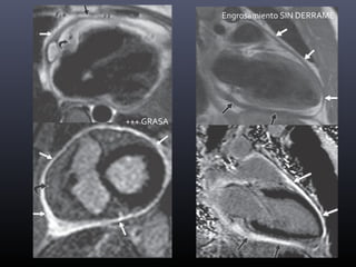 ENGROSAMIENTO +
IRREGULAR
DERRAME
PLEURAL
VARIABLE
REALCE +
AFECTACIÓN
VENTRICULAR
-
PERICARDITIS
CRÓNICA
INFLAMATORIA
Engrosamiento SIN DERRAME
+++ GRASA
 