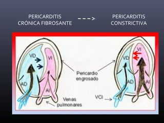 ENGROSAMIENTO + ( señal
si calcio o
fibrosis)
DERRAME
PLEURAL
-
REALCE -
AFECTACIÓN
VENTRICULAR
+ si
constricción
PERICARDITIS
CRÓNICA FIBROSANTE
PERICARDITIS
CONSTRICTIVA
 Engrosamiento,
fibrótico o calcificado
del pericardio que
impide la diástole de Vs
Presión sistémica
GC
 Más frecuente
pericardio
parietal/derecho
 Variantes
Ni engrosamiento ni calcio son diagnósticos de
P. Constrictiva si no hay clínica
 