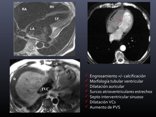 Engrosamiento +/- calcificación
 Morfología tubular ventricular
 Dilatación auricular
 Surcos atrioventriculares estrechos
 Septo interventricular sinuoso
 Dilatación VCs
 Aumento de PVS
 