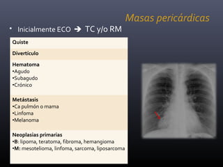 Masas pericárdicas
• Inicialmente ECO TC y/o RM
Quiste
Divertículo
Hematoma
•Agudo
•Subagudo
•Crónico
Metástasis
•Ca pulmón o mama
•Linfoma
•Melanoma
Neoplasias primarias
•B: lipoma, teratoma, fibroma, hemangioma
•M: mesotelioma, linfoma, sarcoma, liposarcoma
 