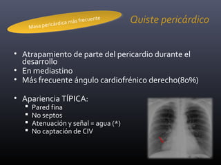 Quiste pericárdico
• Atrapamiento de parte del pericardio durante el
desarrollo
• En mediastino
• Más frecuente ángulo cardiofrénico derecho(80%)
• Apariencia TÍPICA:
 Pared fina
 No septos
 Atenuación y señal = agua (*)
 No captación de CIV
Masa pericárdica más frecuente
Masa pericárdica más frecuente
 