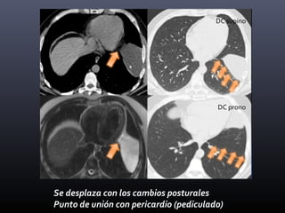 Se desplaza con los cambios posturales
Punto de unión con pericardio (pediculado)
DC supino
DC prono
 