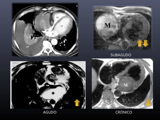 SUBAGUDO
CRÓNICOAGUDO
 