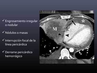 Engrosamiento irregular
o nodular
Nódulos o masas
Interrupción focal de la
línea pericárdica
Derrame pericárdico
hemorrágico
 