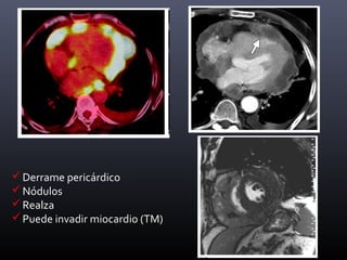 Derrame pericárdico
Nódulos
Realza
Puede invadir miocardio (TM)
 