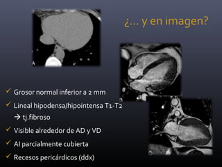 ¿… y en imagen?
 Grosor normal inferior a 2 mm
 Lineal hipodensa/hipointensa T1-T2
 tj.fibroso
 Visible alrededor de AD y VD
 AI parcialmente cubierta
 Recesos pericárdicos (ddx)
 