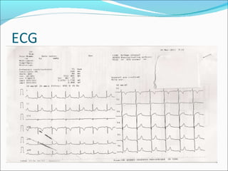 ECG 