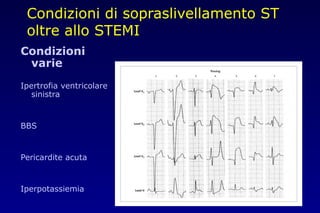 Condizioni di sopraslivellamento ST
oltre allo STEMI
Condizioni
varie
Ipertrofia ventricolare
sinistra
BBS
Pericardite acuta
Iperpotassiemia
 