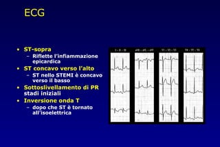 ECG
• ST-sopra
– Riflette l’infiammazione
epicardica
• ST concavo verso l’alto
– ST nello STEMI è concavo
verso il basso
• Sottoslivellamento di PR
stadi iniziali
• Inversione onda T
– dopo che ST è tornato
all’isoelettrica
 