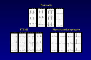 Pericardite
STEMI Ripolarizzazione precoce
 