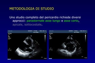 METODOLOGIA DI STUDIO
Uno studio completo del pericardio richiede diversi
approcci: parasternale asse lungo e asse corto,
apicale, sottocostale.
 