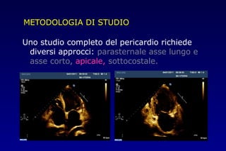 METODOLOGIA DI STUDIO
Uno studio completo del pericardio richiede
diversi approcci: parasternale asse lungo e
asse corto, apicale, sottocostale.
 
