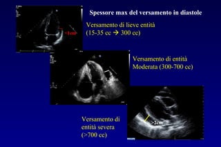>2cm
1.5 cm
<1cm
Versamento di lieve entità
(15-35 cc  300 cc)
Versamento di entità
Moderata (300-700 cc)
Versamento di
entità severa
(>700 cc)
Spessore max del versamento in diastole
 