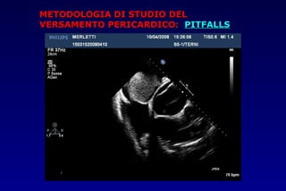 METODOLOGIA DI STUDIO DELMETODOLOGIA DI STUDIO DEL
VERSAMENTO PERICARDICO:VERSAMENTO PERICARDICO: PITFALLSPITFALLS
 