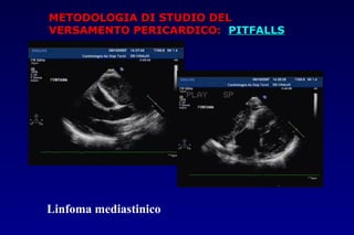 METODOLOGIA DI STUDIO DELMETODOLOGIA DI STUDIO DEL
VERSAMENTO PERICARDICO:VERSAMENTO PERICARDICO: PITFALLSPITFALLS
Linfoma mediastinico
 