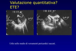 Valutazione quantitativa?
ETE?
Utile nello studio di versamenti pericardici saccati.
 