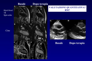 VALUTAZIONE QUANTITATIVA?
RM?
Basale Dopo terapia
Basale Dopo terapia
Black blood
T2
Spin echo
Cine
L.E.
 