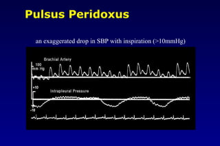 Pulsus Peridoxus
an exaggerated drop in SBP with inspiration (>10mmHg)
 
