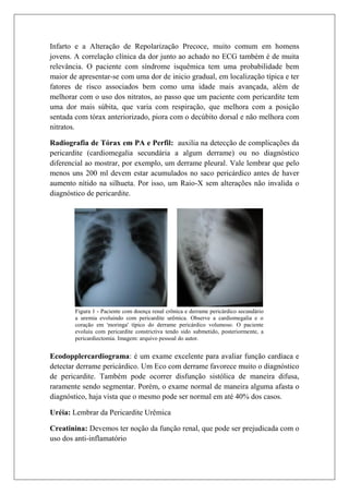 Infarto e a Alteração de Repolarização Precoce, muito comum em homens
jovens. A correlação clínica da dor junto ao achado no ECG também é de muita
relevância. O paciente com síndrome isquêmica tem uma probabilidade bem
maior de apresentar-se com uma dor de inicio gradual, em localização típica e ter
fatores de risco associados bem como uma idade mais avançada, além de
melhorar com o uso dos nitratos, ao passo que um paciente com pericardite tem
uma dor mais súbita, que varia com respiração, que melhora com a posição
sentada com tórax anteriorizado, piora com o decúbito dorsal e não melhora com
nitratos.

Radiografia de Tórax em PA e Perfil: auxilia na detecção de complicações da
pericardite (cardiomegalia secundária a algum derrame) ou no diagnóstico
diferencial ao mostrar, por exemplo, um derrame pleural. Vale lembrar que pelo
menos uns 200 ml devem estar acumulados no saco pericárdico antes de haver
aumento nítido na silhueta. Por isso, um Raio-X sem alterações não invalida o
diagnóstico de pericardite.




        Figura 1 - Paciente com doença renal crônica e derrame pericárdico secundário
        a uremia evoluindo com pericardite urêmica. Observe a cardiomegalia e o
        coração em 'moringa' típico do derrame pericárdico volumoso. O paciente
        evoluiu com pericardite constrictiva tendo sido submetido, posteriormente, a
        pericardiectomia. Imagem: arquivo pessoal do autor.


Ecodopplercardiograma: é um exame excelente para avaliar função cardíaca e
detectar derrame pericárdico. Um Eco com derrame favorece muito o diagnóstico
de pericardite. Também pode ocorrer disfunção sistólica de maneira difusa,
raramente sendo segmentar. Porém, o exame normal de maneira alguma afasta o
diagnóstico, haja vista que o mesmo pode ser normal em até 40% dos casos.

Uréia: Lembrar da Pericardite Urêmica

Creatinina: Devemos ter noção da função renal, que pode ser prejudicada com o
uso dos anti-inflamatório
 