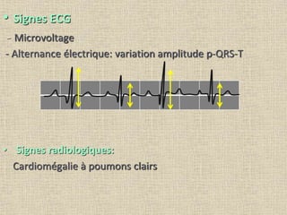 • Signes ECG
- Microvoltage
- Alternance électrique: variation amplitude p-QRS-T
• Signes radiologiques:
Cardiomégalie à poumons clairs
 