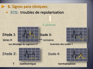 ► B. Signes para cliniques:
• ECG: troubles de repolarisation
4 phases
Stade 1: Stade 3:
1ères H 2ème semaine
sus décalage du segment ST inversion des ondes T
Stade 2: Stade 4:
T isoélectrique normalisation
 