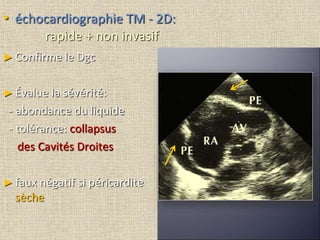 • échocardiographie TM - 2D:
rapide + non invasif
► Confirme le Dgc
► Évalue la sévérité:
- abondance du liquide
- tolérance: collapsus
des Cavités Droites
► faux négatif si péricardite
sèche
 