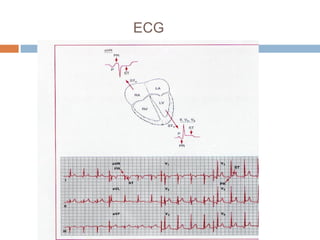 ECG
 