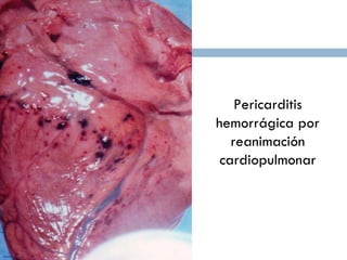 Pericarditis hemorrágica por reanimación cardiopulmonar 
