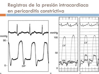 Registros de la presión intracardiaca en pericarditis constrictiva 