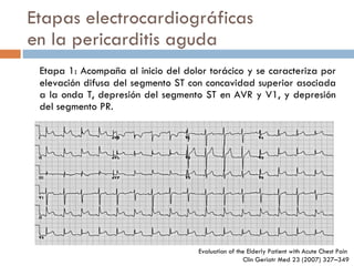Etapas electrocardiográficas en la pericarditis aguda Etapa 1: Acompaña al inicio del dolor torácico y se caracteriza por elevación difusa del segmento ST con concavidad superior asociada a la onda T, depresión del segmento ST en AVR y V1, y depresión del segmento PR. Evaluation of the Elderly Patient  with Acute Chest Pain  Clin Geriatr Med 23 (2007) 327–349 
